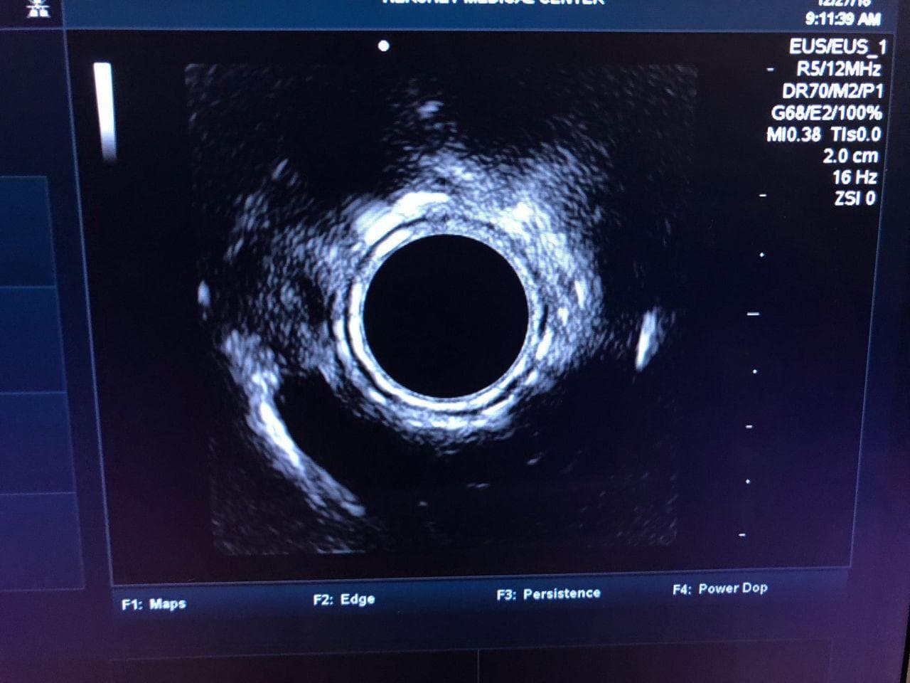 Fujinon EG-530UR Ultrasound Gastroscope for Endoscopic Ultrasonography thumbnail 5