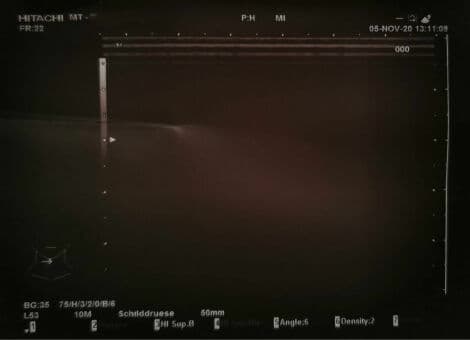 Vascular and Small Parts Imaging with the Hitachi EUP-L53 Linear Ultrasound Transducer thumbnail 2