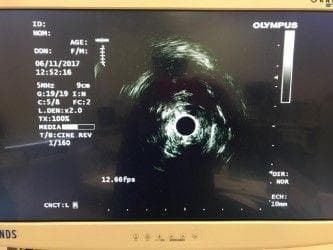Olympus GF-UE160-AL5 Ultrasound Video Gastroscope for EUS Procedures thumbnail 7