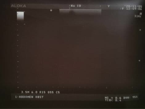 Biopsy-Guided Ultrasound Imaging — Aloka UST-5045 P Linear Transducer thumbnail 2