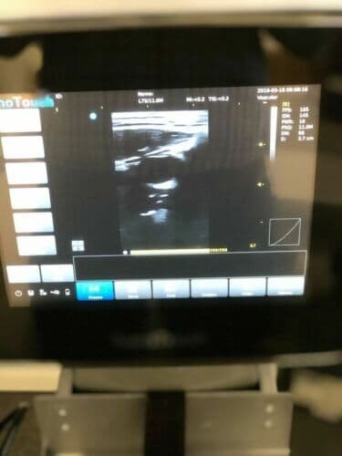 CHISON L7s Linear Array Ultrasound Probe thumbnail 3
