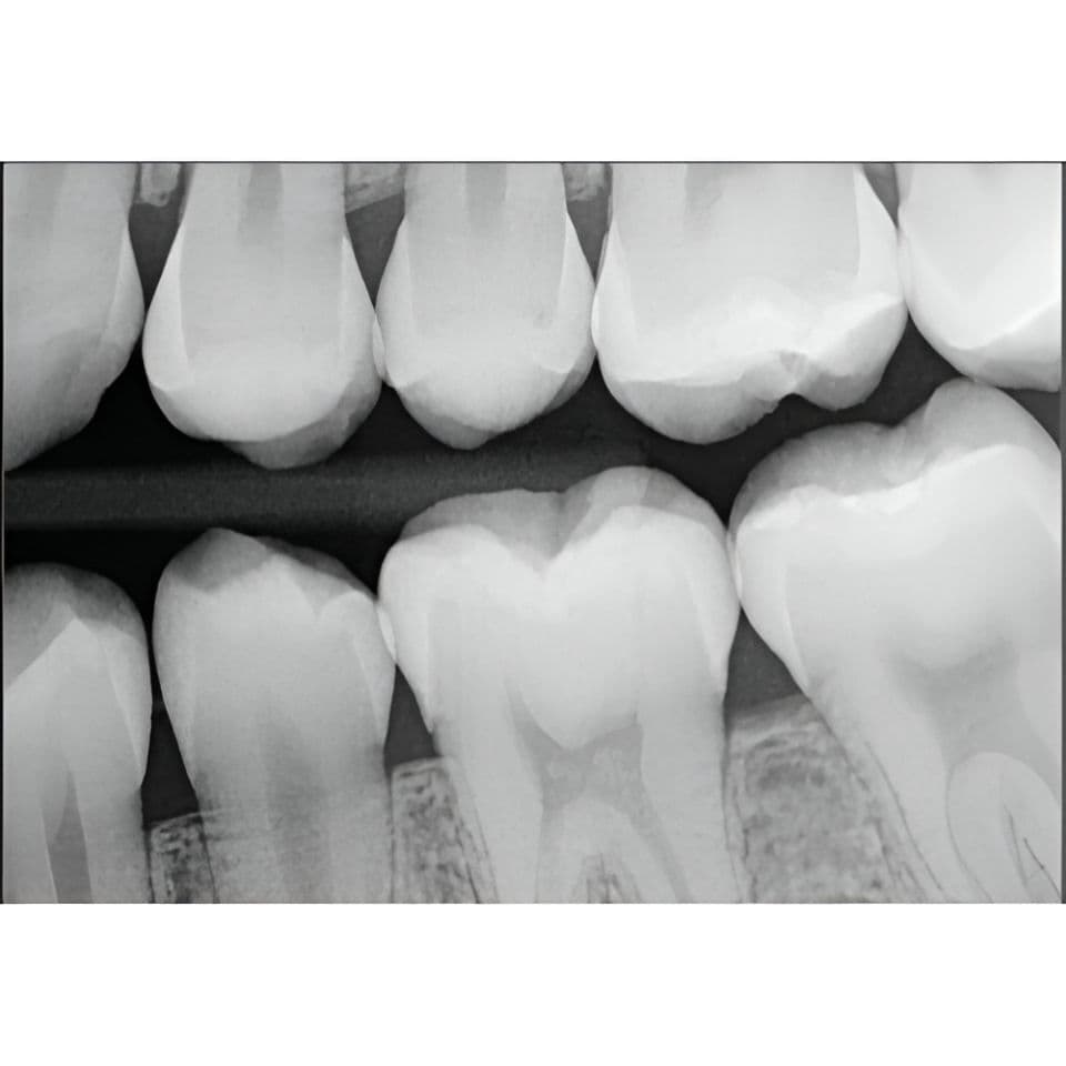 Schick CDR Elite Size 2 Digital Dental Sensors thumbnail 6