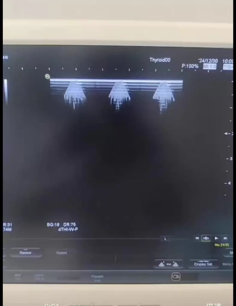 Hitachi Avius ultrasound machine repair (RDBF beamformer board) Artifact Imaging