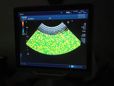 GE S1-5-D Sector Ultrasound Transducer for Logiq E9 & S8 Systems thumbnail 5
