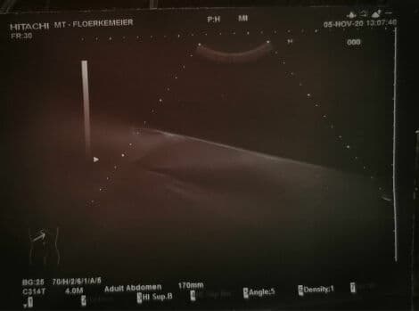 Abdominal Imaging Convex Ultrasound Transducer — Hitachi EUP-C314T thumbnail 2