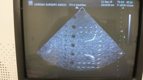 ATL P3-2 Cardiac Sector Ultrasound Transducer thumbnail 4