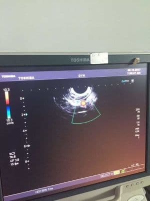 AKICARE PVT-661VT Endocavity Ultrasound Transducer for Toshiba