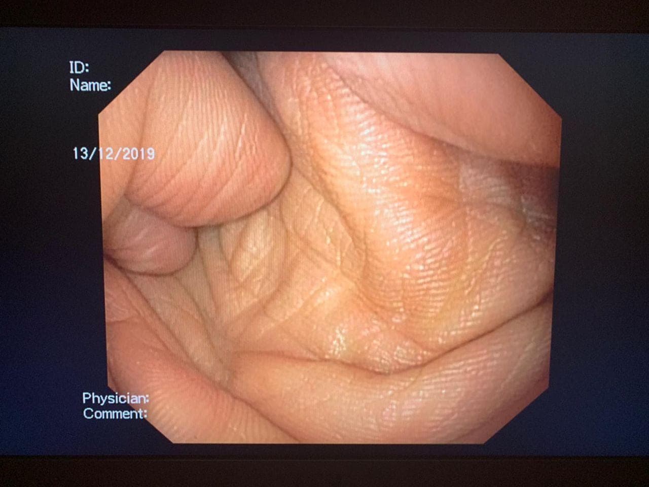 Olympus GIF-Q180 Video Gastroscope for Upper GI Endoscopy thumbnail 3