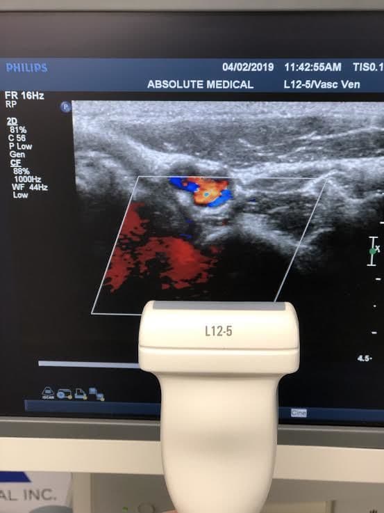 Philips L12-5 Linear Array Vascular Ultrasound Transducer Probe