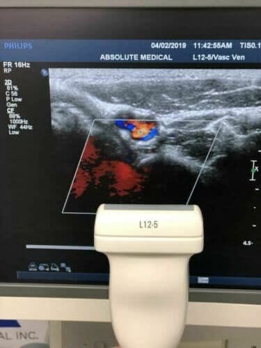 Philips L12-5 Linear Array Ultrasound Transducer Probe