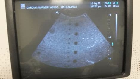 ATL C5-2 Curved Linear Ultrasound Transducer