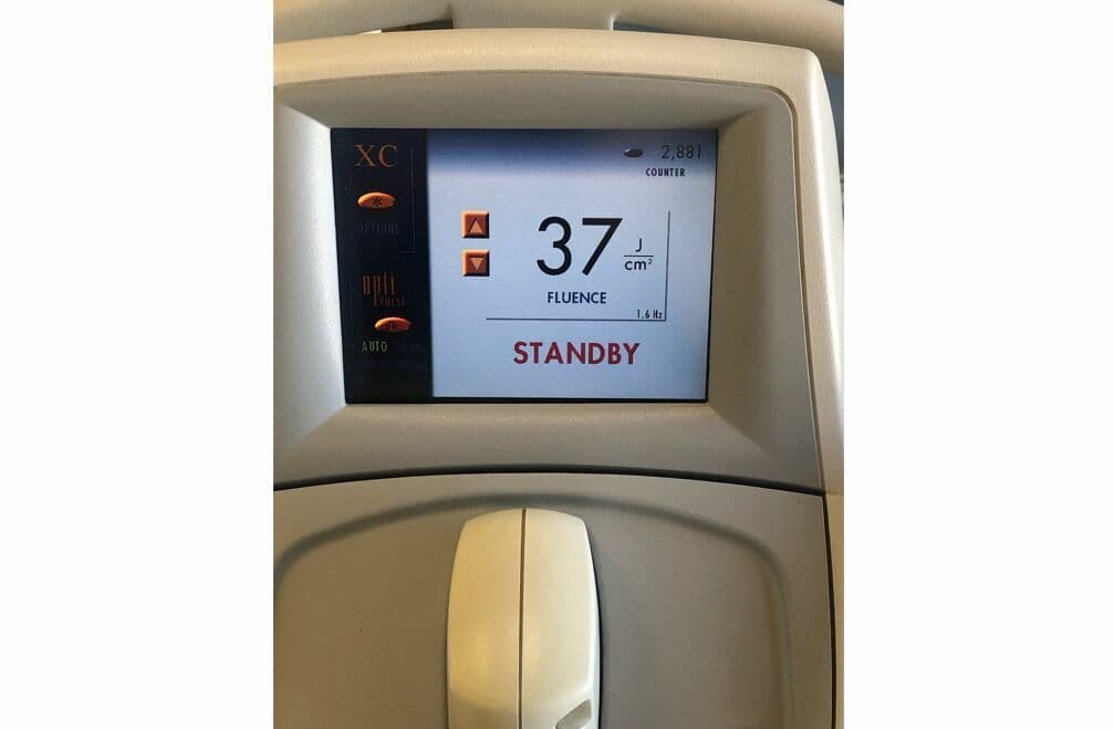 Lumenis LightSheer XC Diode Laser System