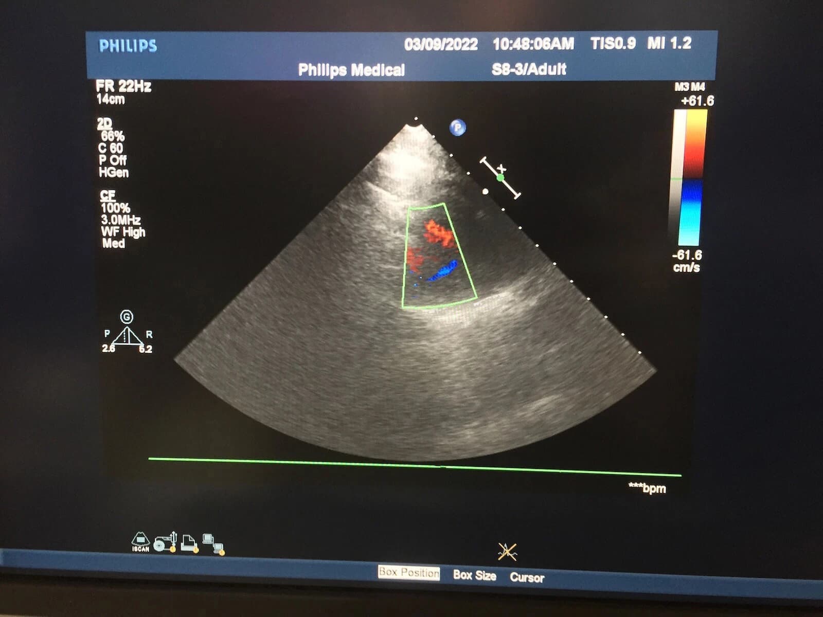 Philips S8-3 Cardiac Ultrasound Probe for iU22, iE33, HD11 XE and HD15 Systems – Large Connector Sector Array Transducer