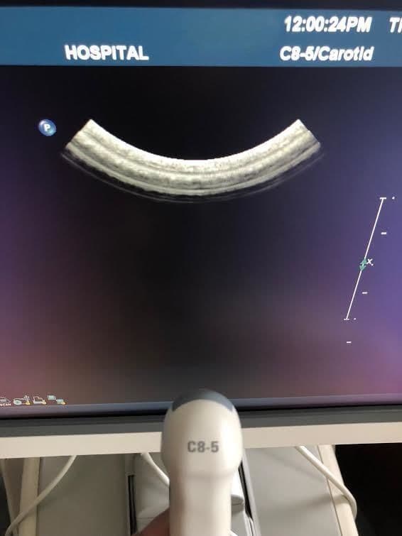 Philips C8-5 Micro Convex Ultrasound Transducer