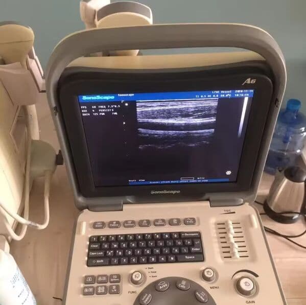 SonoScape A6 Portable B/W Ultrasound Scanner